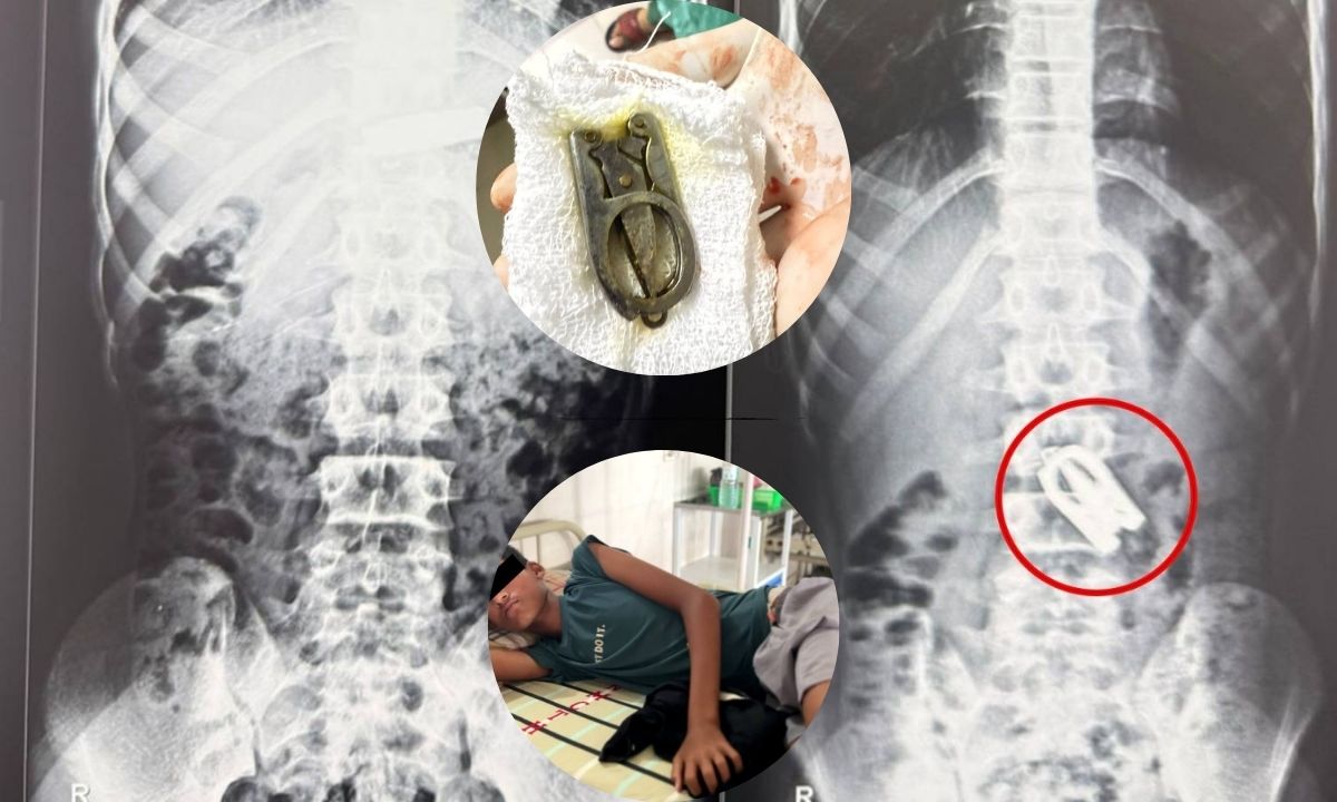 Scissors removed from 15-year-old boy's stomach