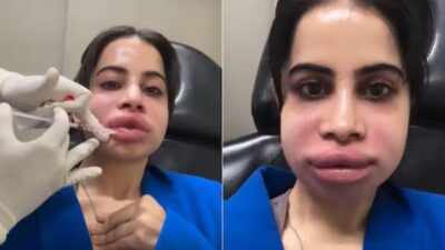Uorfi Javed opens up about painful journey of removing lip fillers after 9 years