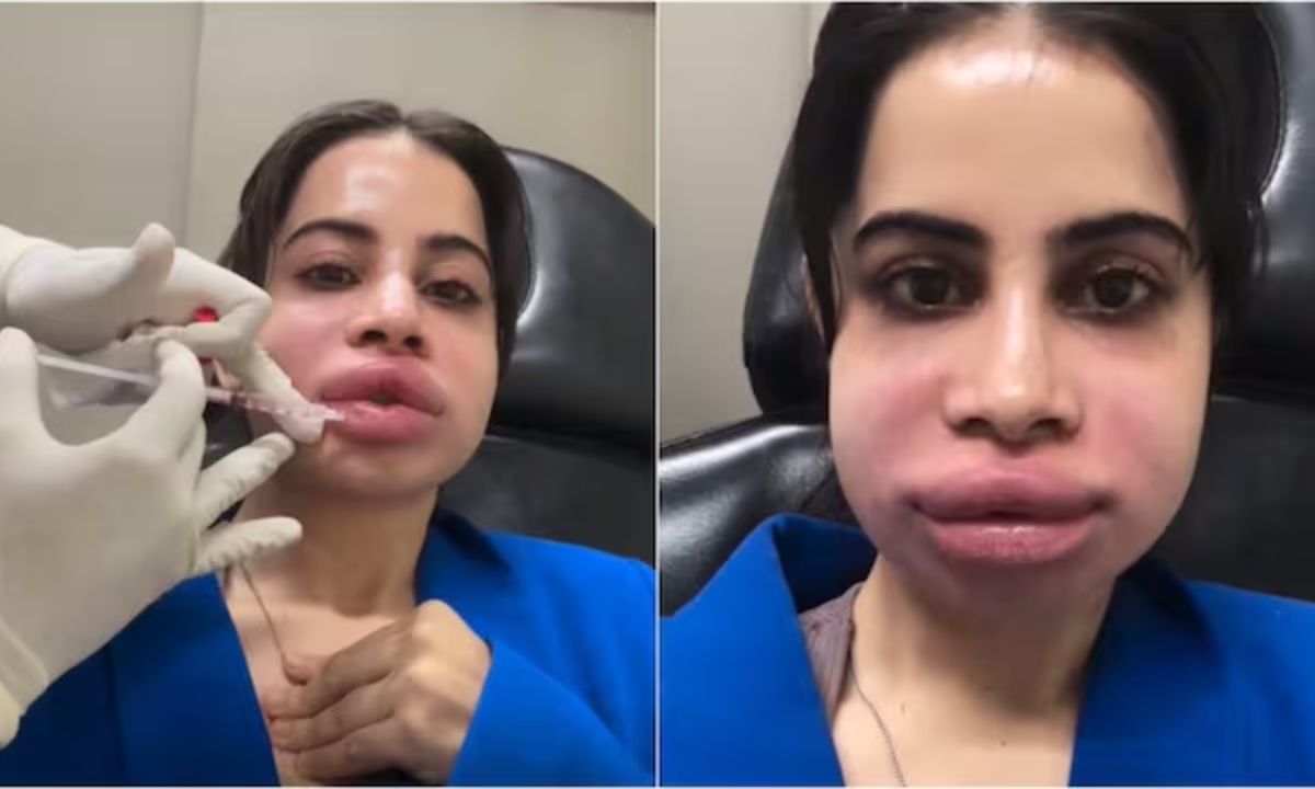 Uorfi Javed opens up about painful journey of removing lip fillers after 9 years
